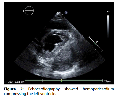 interventional-cardiology-Coil-embolization