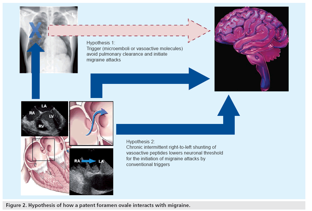 interventional-cardiology-interacts-migraine