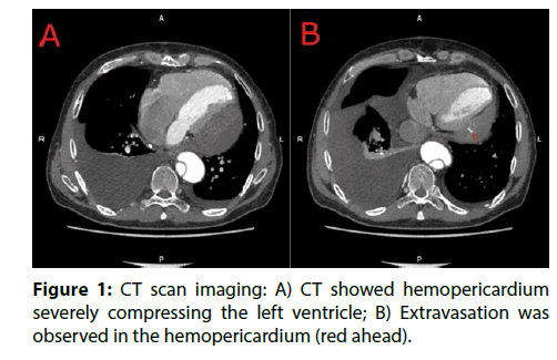 interventional-cardiology-left-ventricle