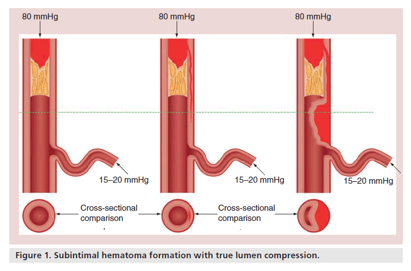 interventional-cardiology-lumen-compression