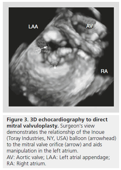 interventional-cardiology-mitral-valvuloplasty