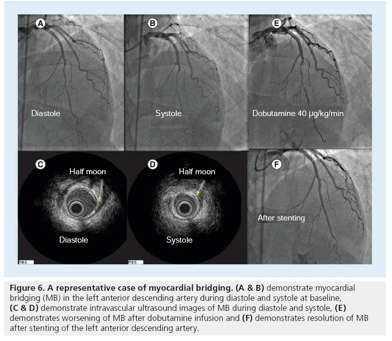 interventional-cardiology-myocardial-bridging