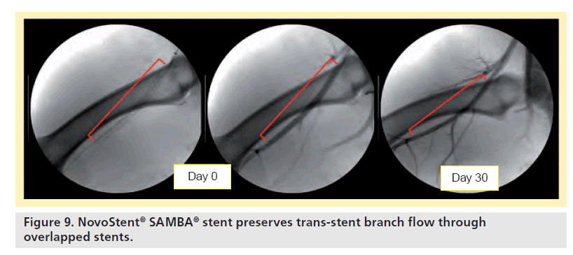 interventional-cardiology-overlapped-stents