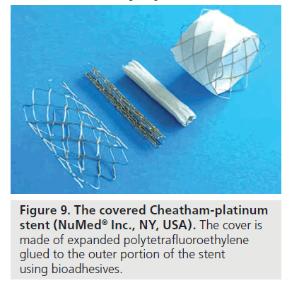 stent covered aorta coarctation polytetrafluoroethylene implantation outcomes indications techniques materials platinum numed glued expanded cheatham ny inc usa figure cover