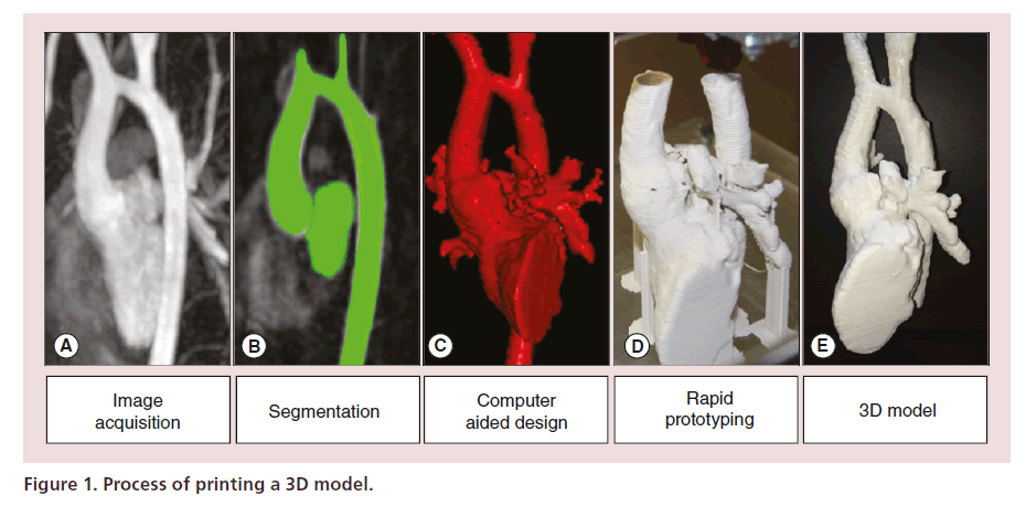 interventional-cardiology-printing-3D-model