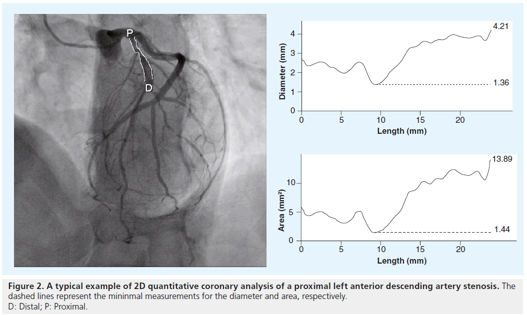 interventional-cardiology-proximal-anterior