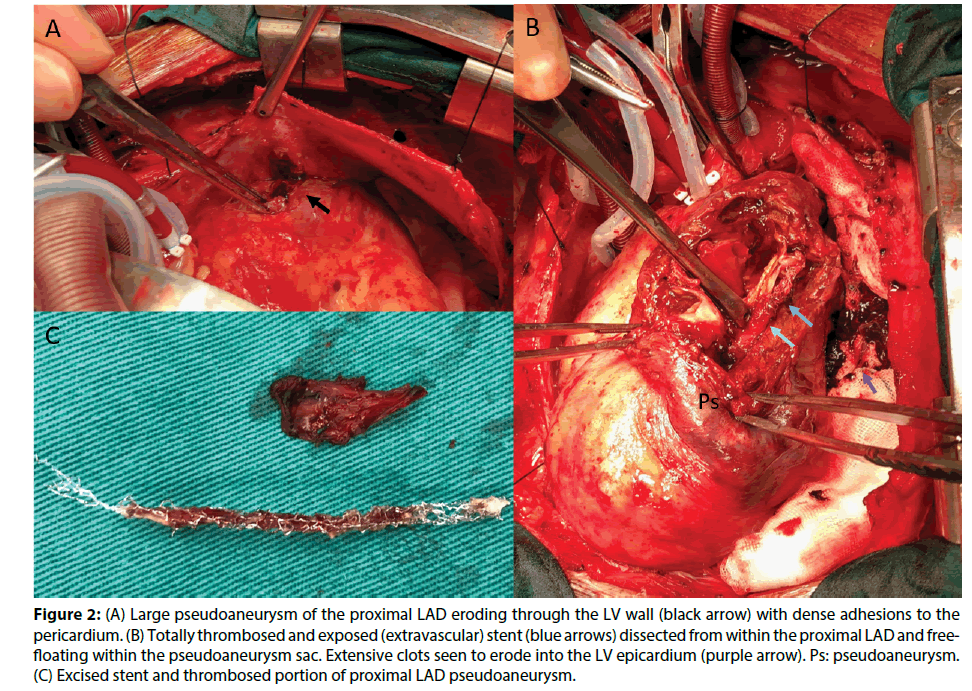 interventional-cardiology-pseudoaneurysm-proximal