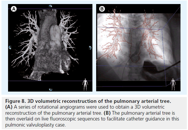interventional-cardiology-pulmonary-tree