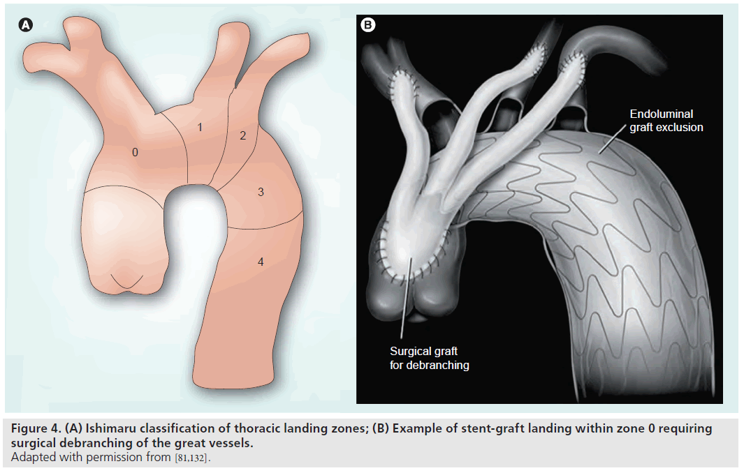 interventional-cardiology-stent-graft-landing