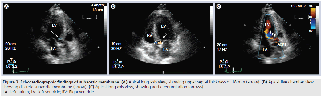 interventional-cardiology-subaortic