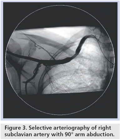 interventional-cardiology-subclavian-artery