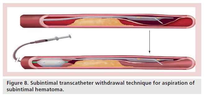 interventional-cardiology-subintimal-hematoma