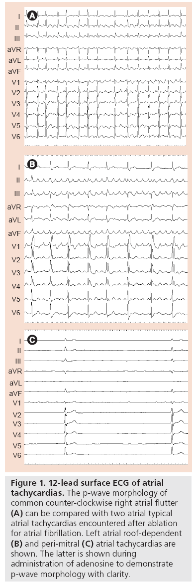 interventional-cardiology-surface-ECG