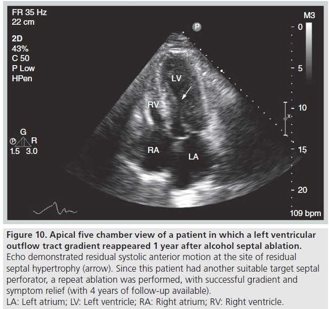 interventional-cardiology-systolic