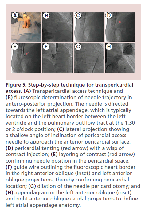 interventional-cardiology-technique-transpericardial