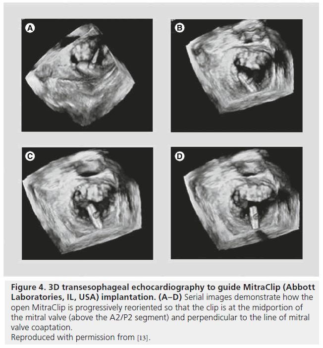 interventional-cardiology-transesophageal-echocardiography