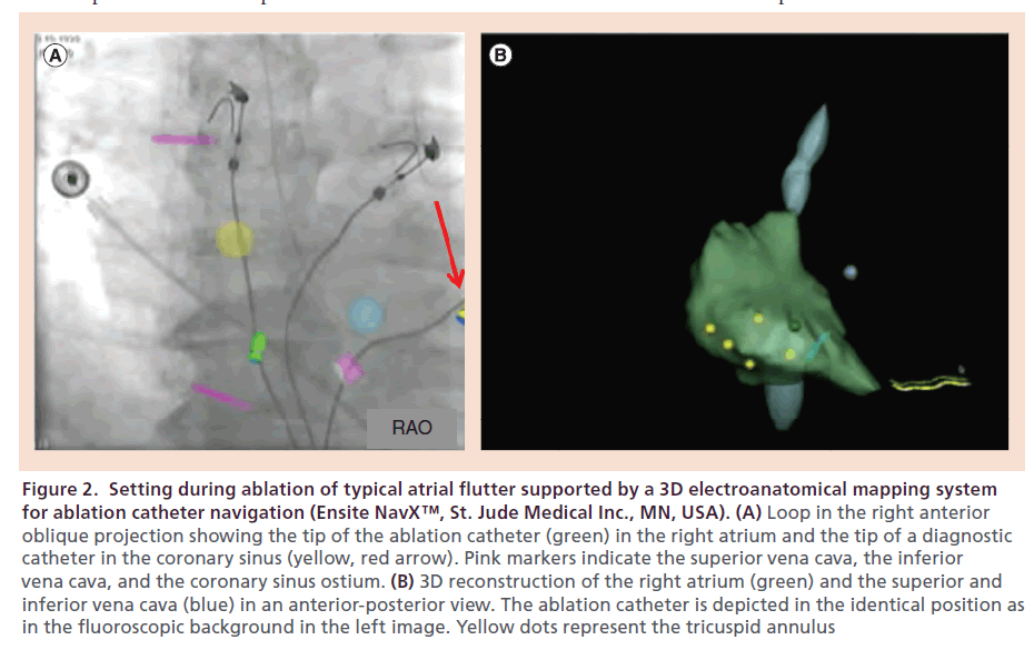 interventional-cardiology-tricuspid-annulus