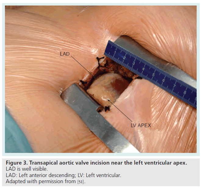 interventional-cardiology-ventricular-apex